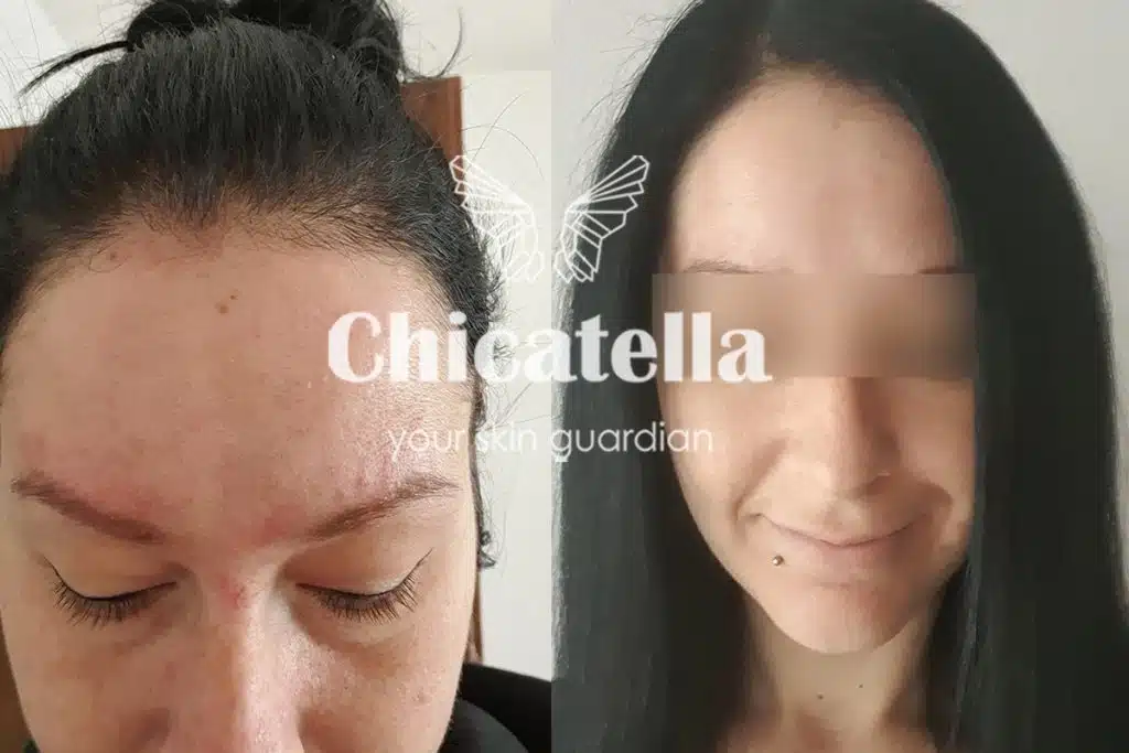 Atopijski dermatitis 13