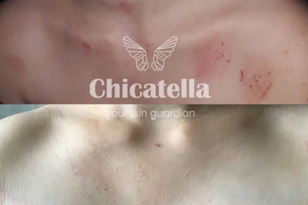 Dermatitis 12