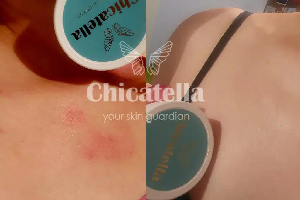 Dermatitis 13
