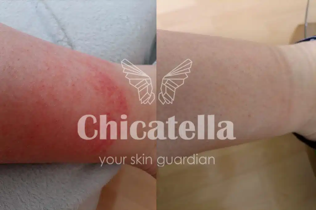 Dermatitis 2