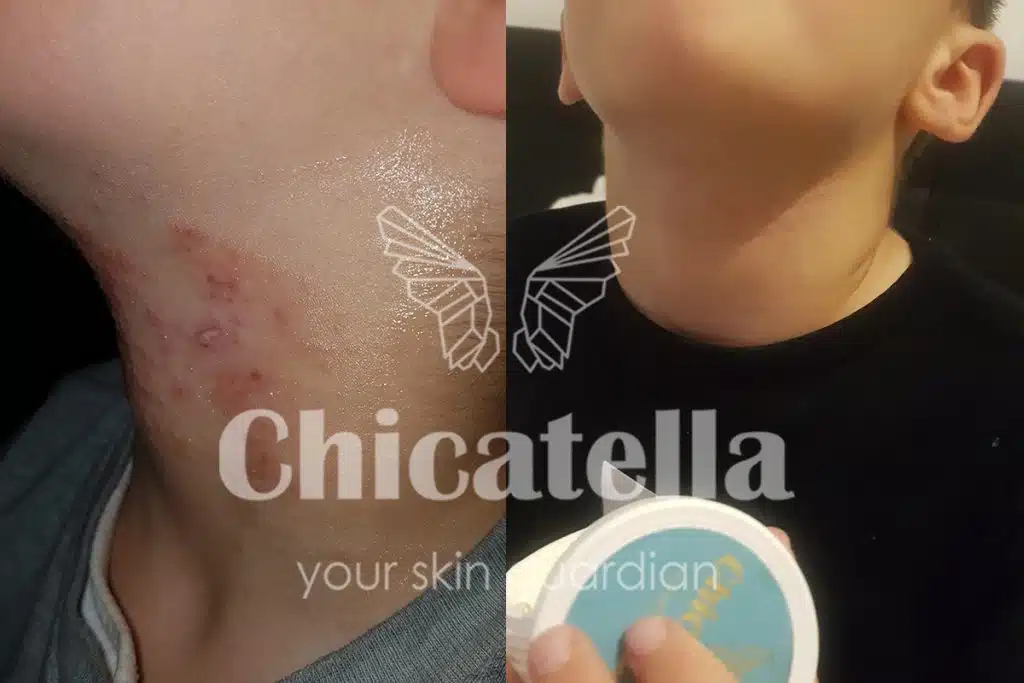 Dermatitis 3