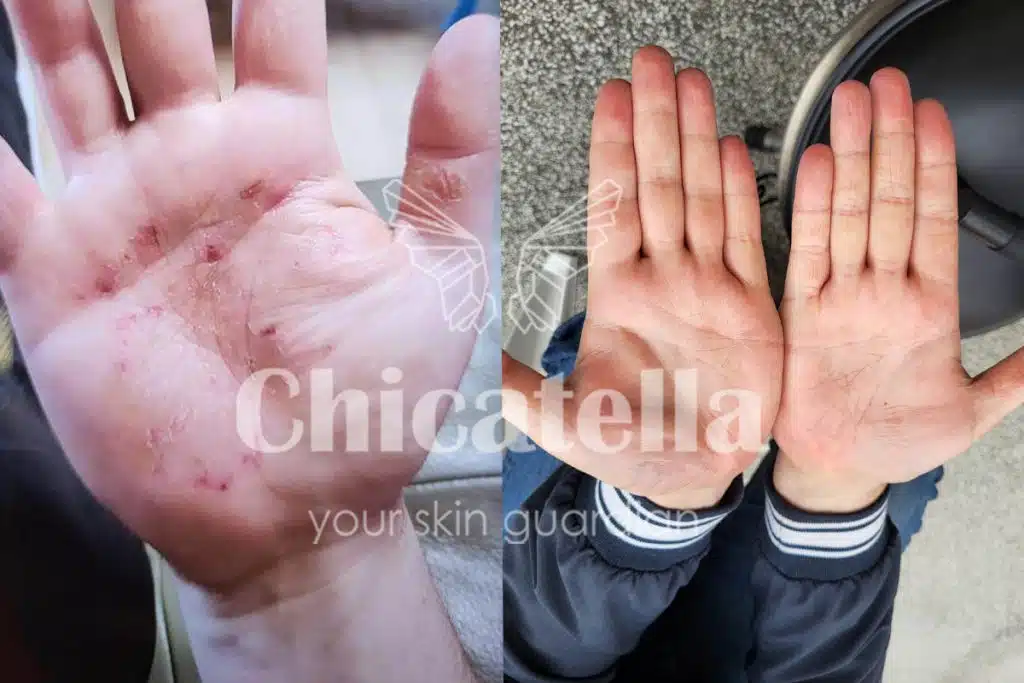 Dermatitis 5