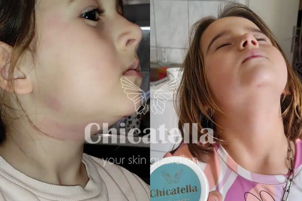 Dermatitis 8