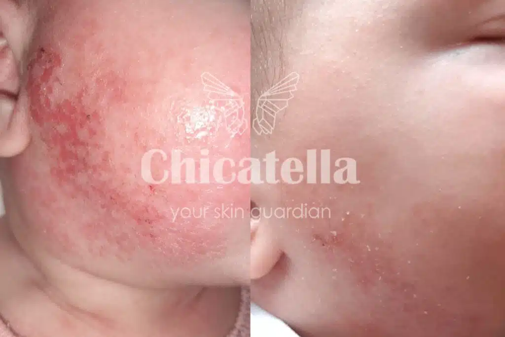 Dermatitis 9