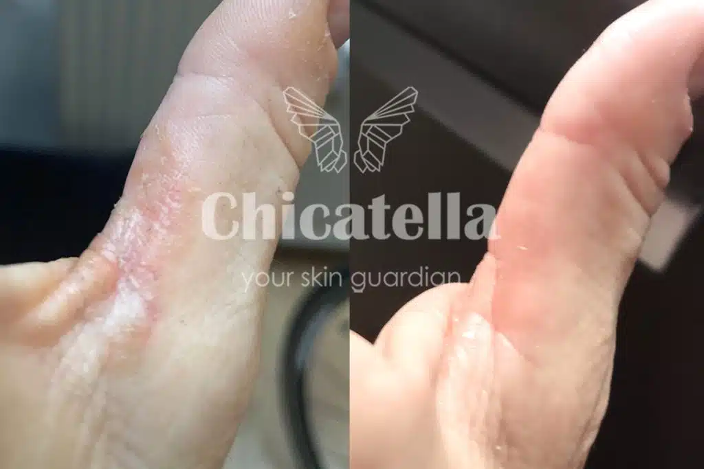 Kontaktni dermatitis 4